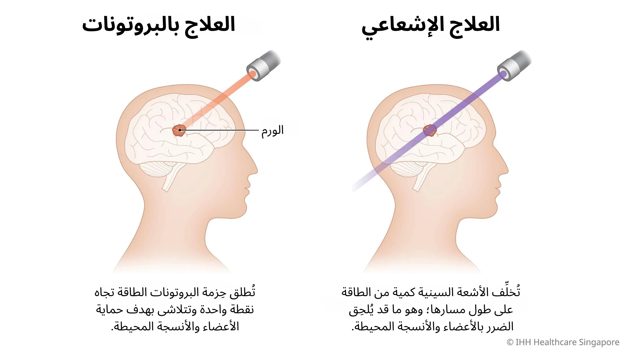 العلاج بشعاع البروتون مقابل العلاج الإشعاعي