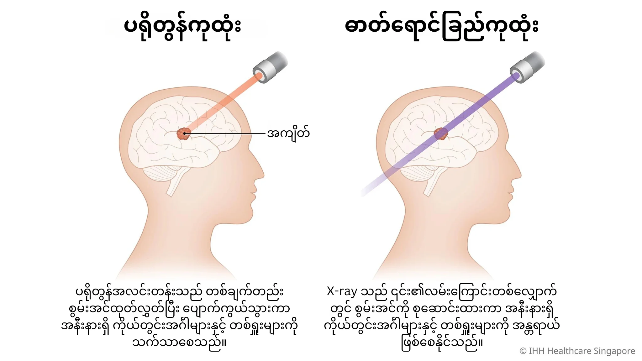 ပရိုတွန်အလင်းတန်းကုထုံးနှင့် ဓာတ်ရောင်ခြည်ကုထုံး