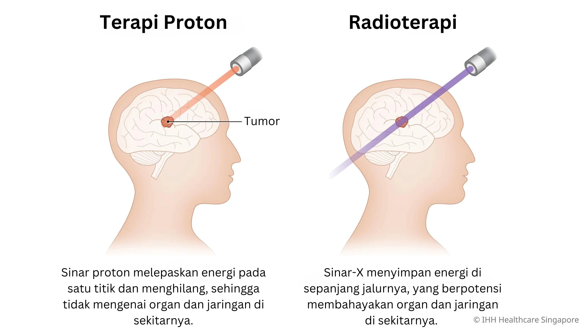 Terapi Sinar Proton vs Radioterapi