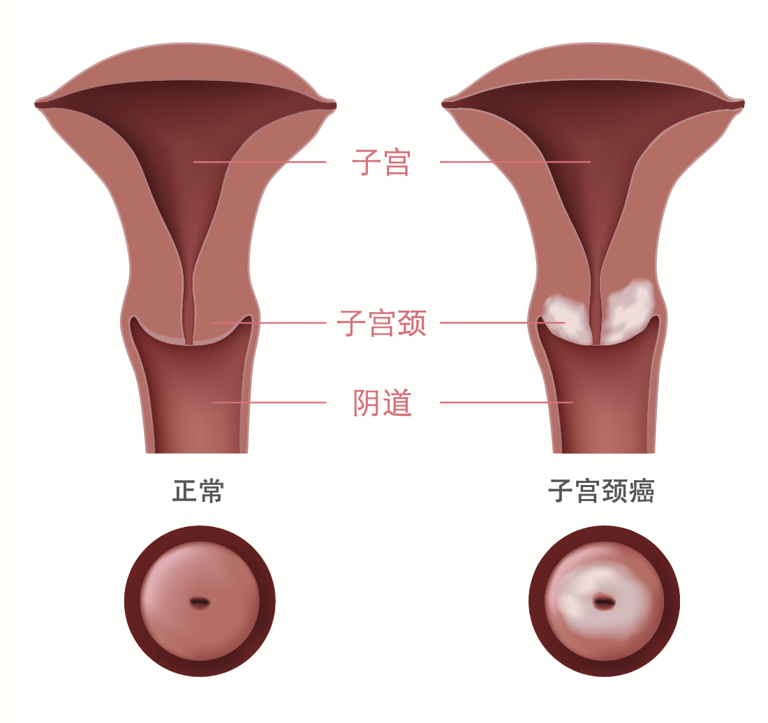 子宫颈癌 宫颈癌 体征 诊断 及在新加坡接受治疗 百汇癌症中心新加坡