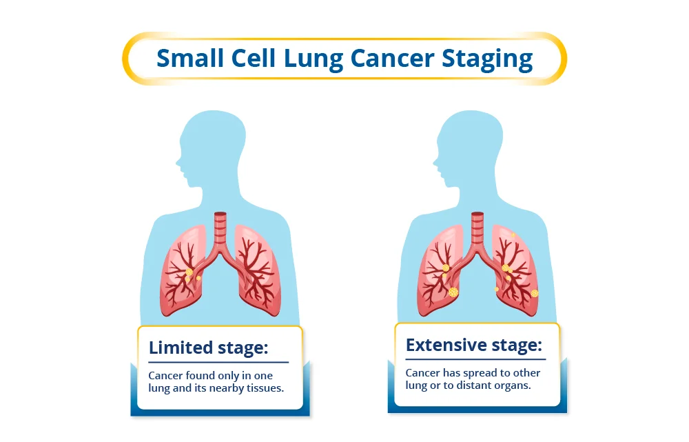 Stages of Small Cell Lung Cancer