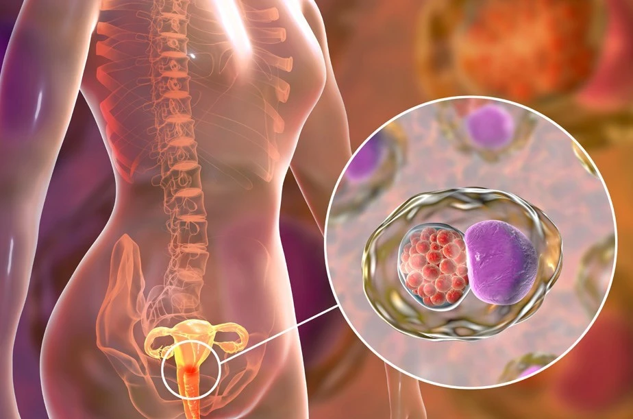 digital illustration of female reproductive system and cancer cells in cervix