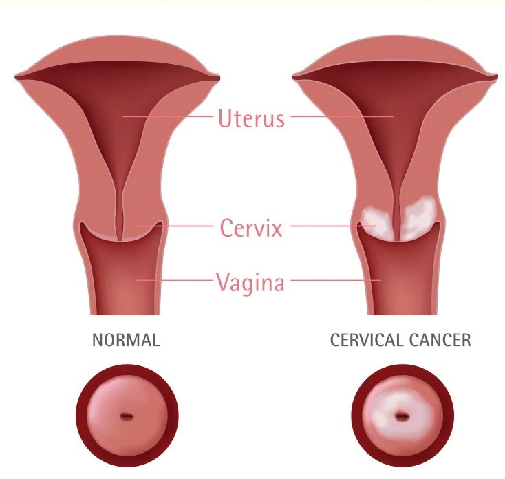 Philippine Commission on Women - Pelvic pain, vaginal bleeding and watery,  vaginal discharge are the common symptoms of cervical cancer. When  experiencing these, be sure to consult your doctor. Health experts advise