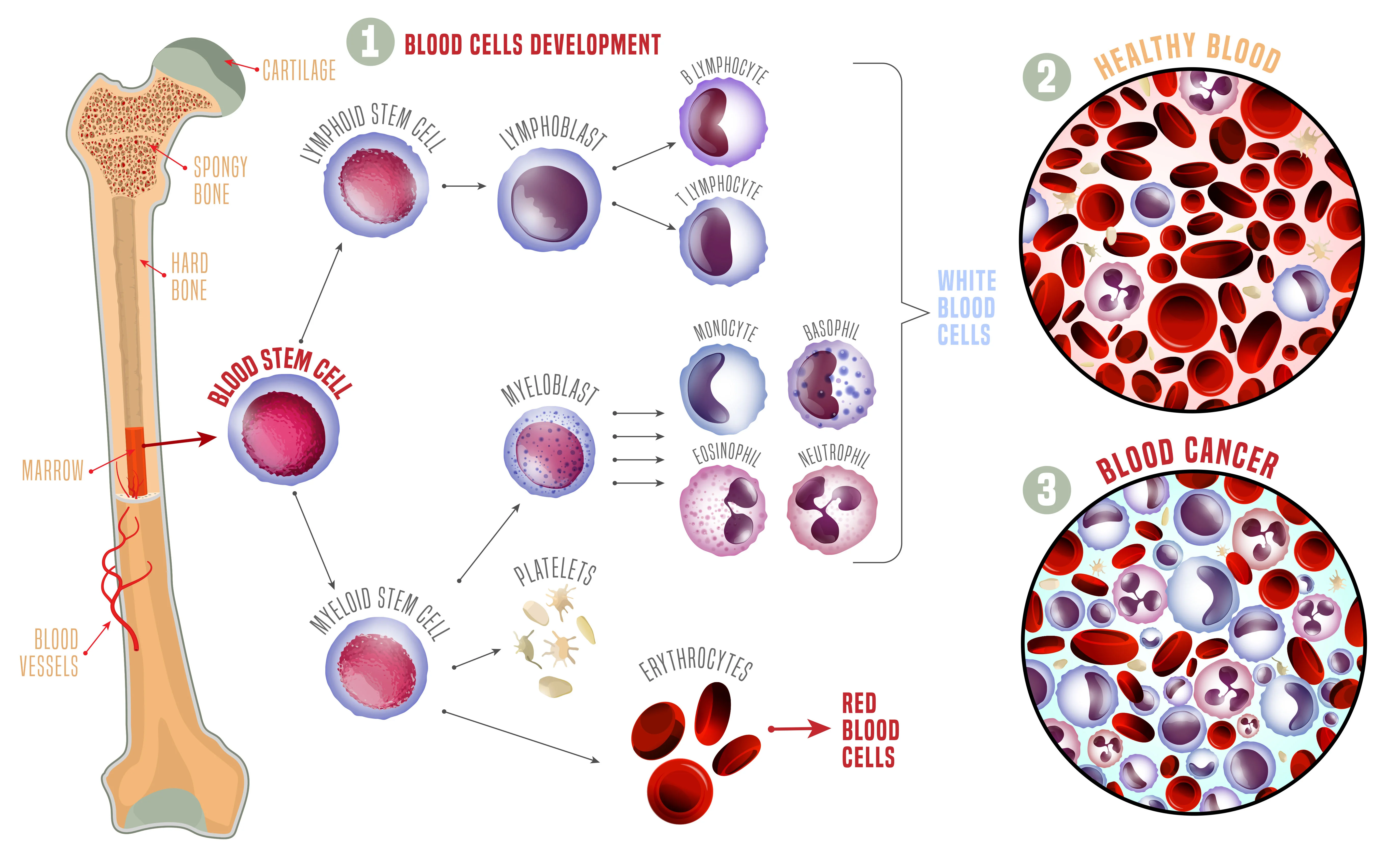 Blood Cancer Infographic