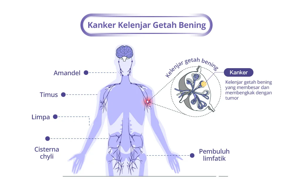 anatomi kanker kelenjar getah bening