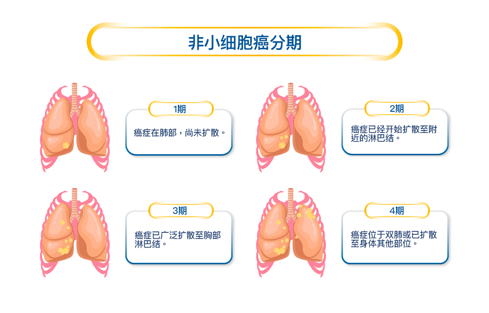 Stages of Non–Small Cell Lung Cancer