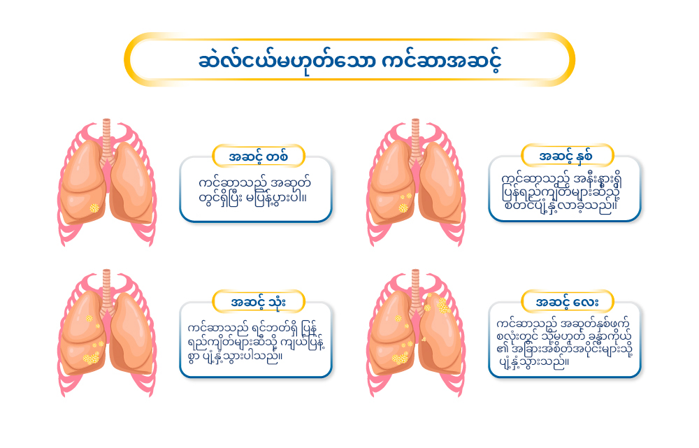 Stages of Non–Small Cell Lung Cancer