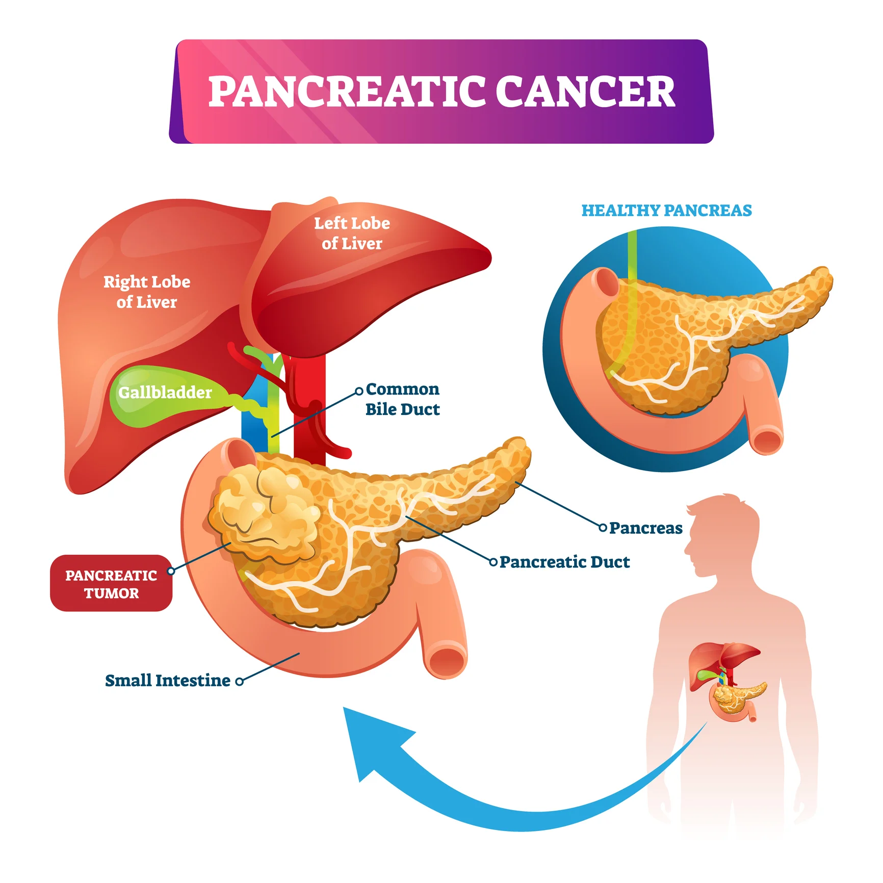 pancreatic cancer infographic