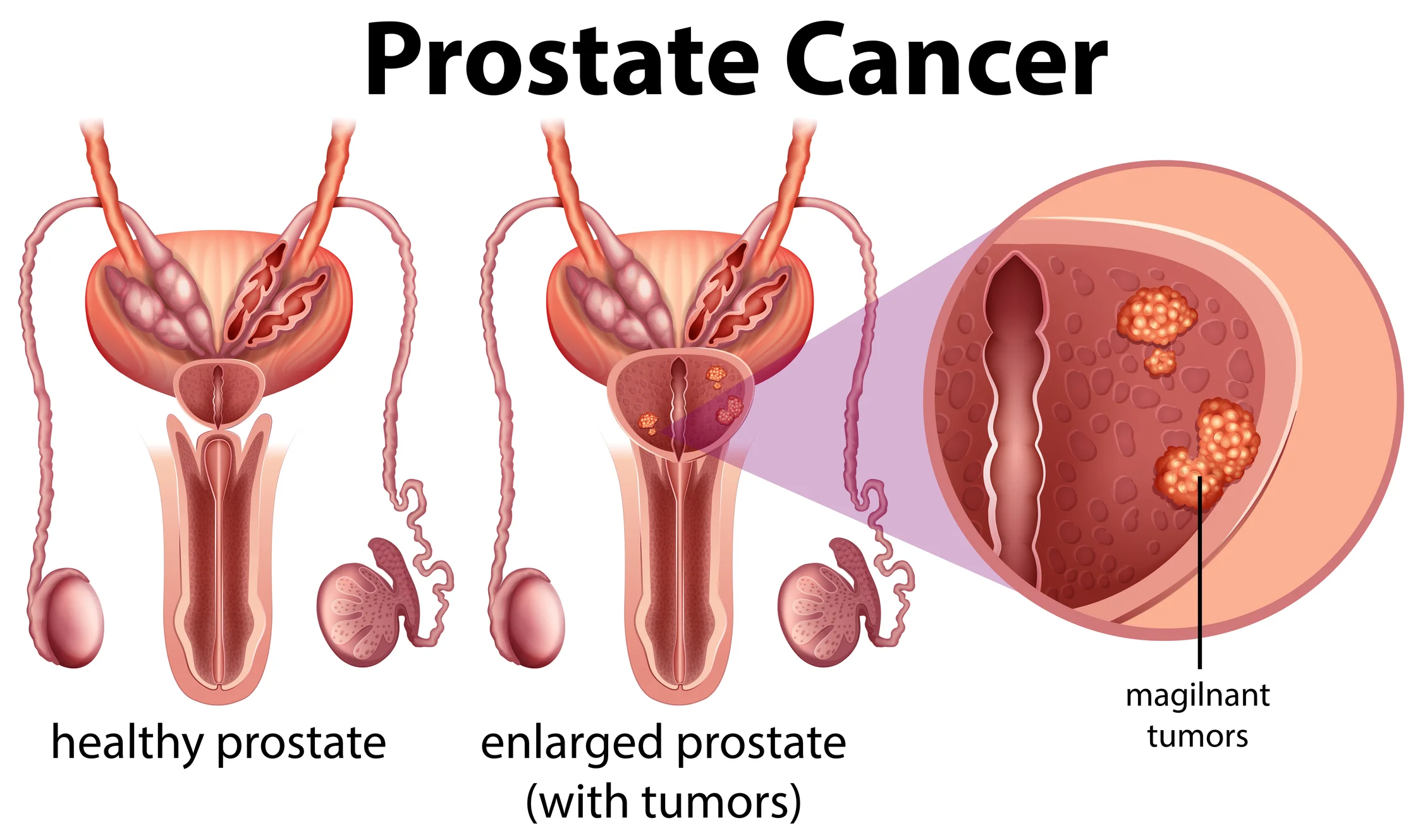 prostate cancer infographic