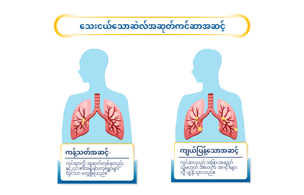 Stages of Small Cell Lung Cancer