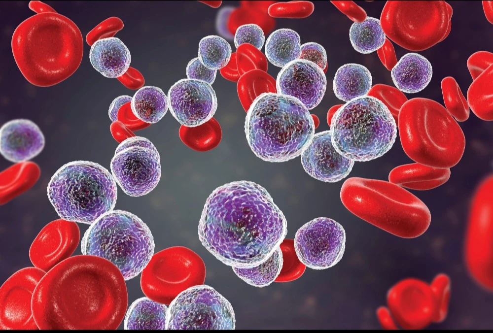 Leukemia Limfositik Kronis (LLK): Tanda, Diagnosis & Perawatan Di ...