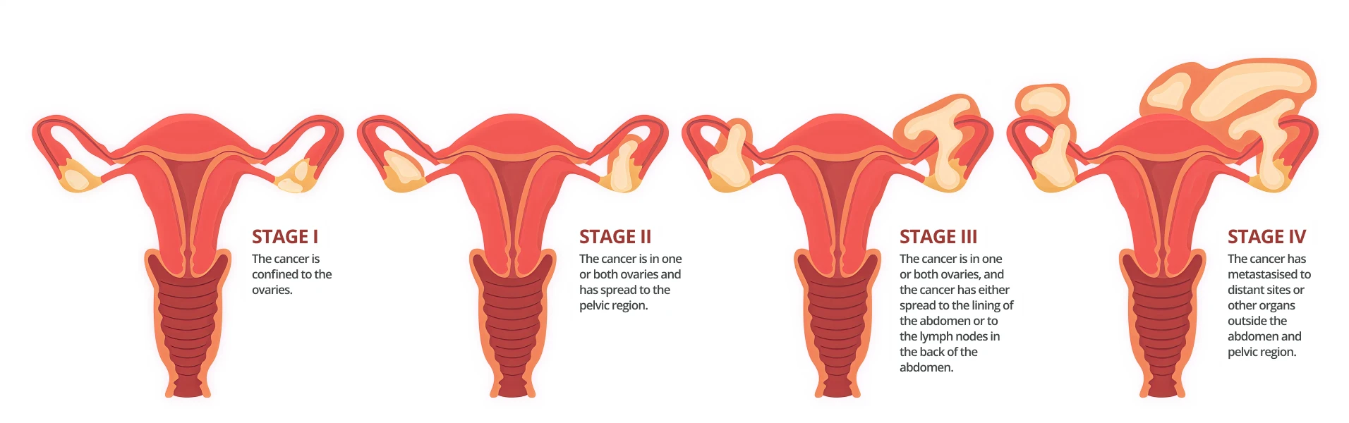 illustration of cancer stages