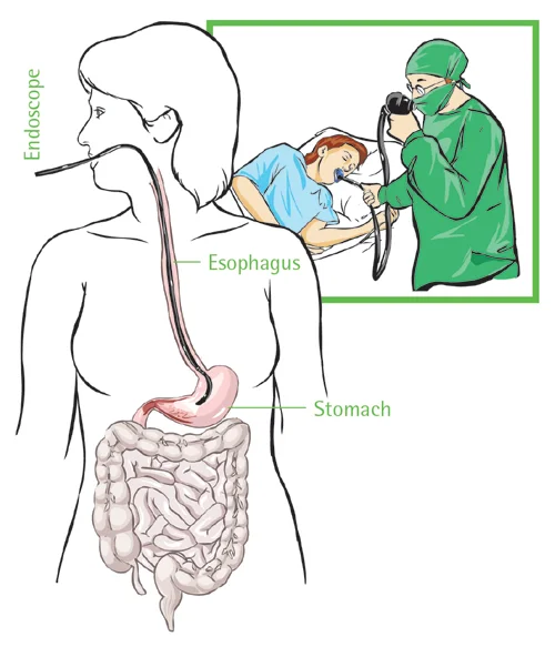 gastroscopy in singapore