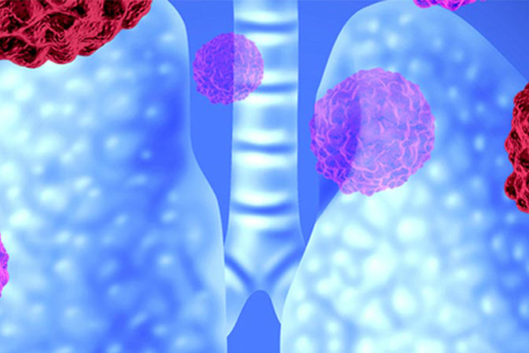 real alternative medicine for small cell lung cancer
