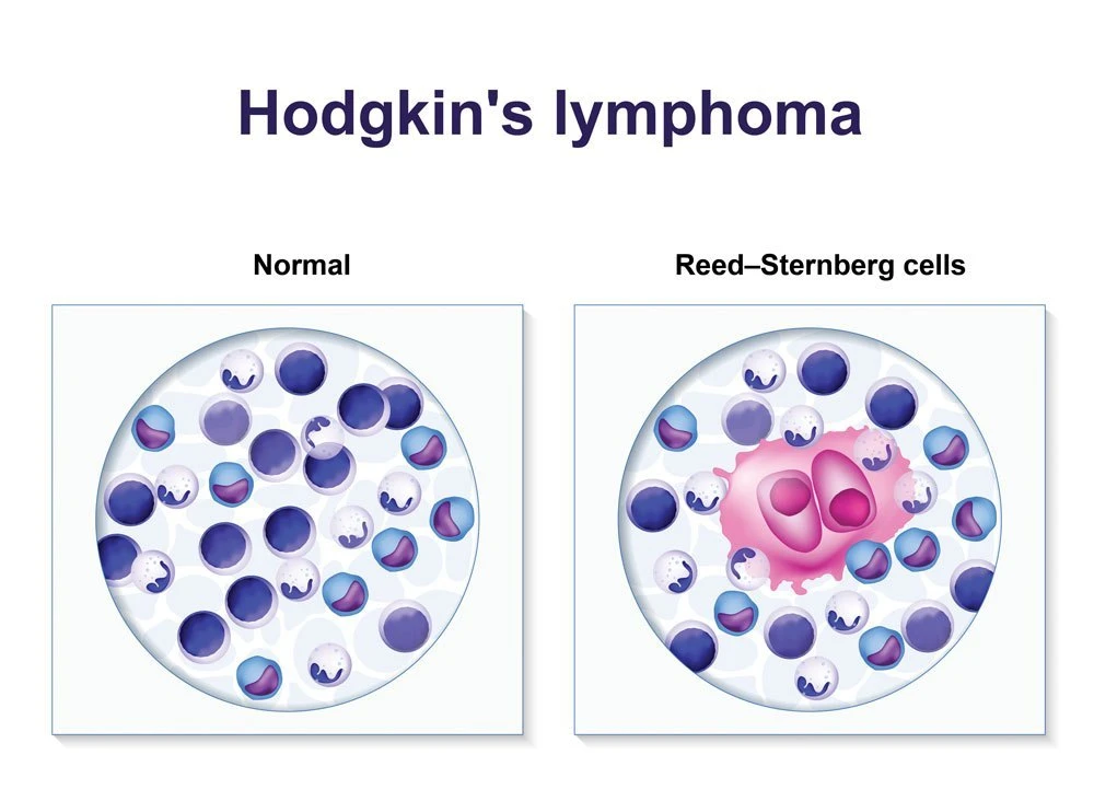 Limfoma Hodgkin (Penyakit Hodgkin): Tanda, Diagnosis & Perawatan Di ...