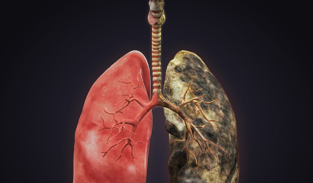 What Is Advanced Lung Cancer