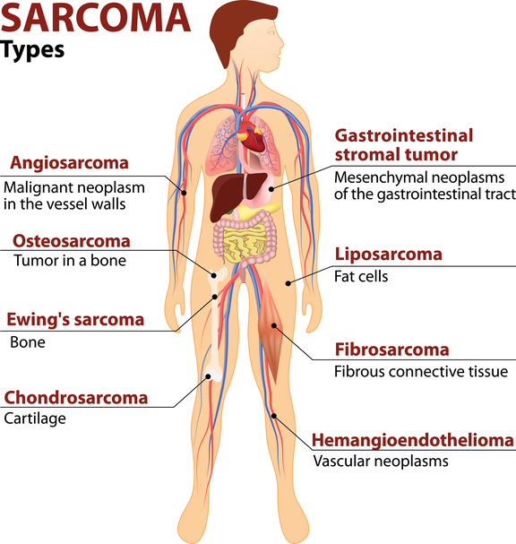 Soft Tissue Sarcoma